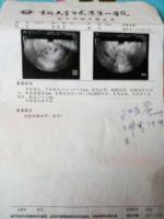 Uterinefibroidsdisappear1.jpg